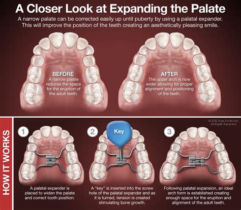 This reason is why orthodontists avoid elaborating people how <b>palate</b> <b>expander</b> works. . Palatal expander side effects nose